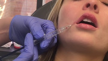 MedAesthetics Micro Cannula Lip Injections