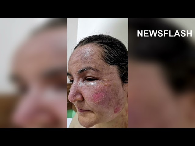 Turkish Hubby Scolds Wifes Face With Hot Oil