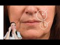 Facial massage for the nasolabial folds