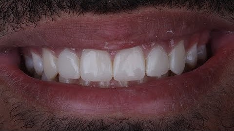 Anterior direct composite resin - layering of multiple teeth in one visit hands-on