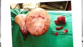 Définitions Types Des Kystes Ovariens