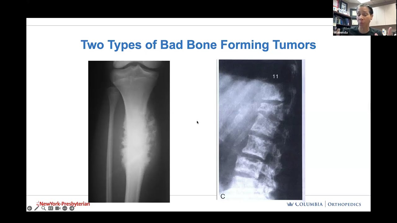 Bone Tumor : Physical & Radiologic findings and Treatment - Wakenda Tyler, M.D. | HOGR-HUP 2025