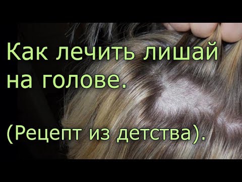 Чем лечить стригущий лишай у ребенка на голове в домашних условиях