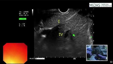 EUS evaluation of liver part 1