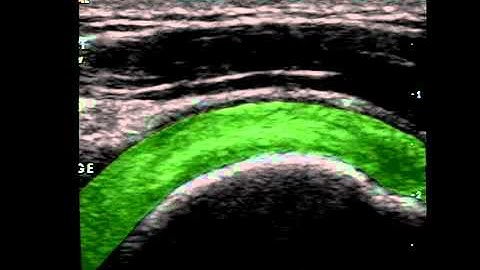 Musculoskeletal Ultrasound: Shoulder 5: impingement test