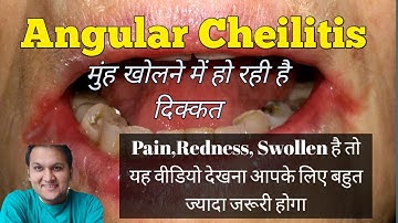 Angular Cheilitis: Cause, Symptoms, Risk Facors and Treatment