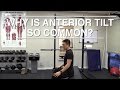 Why is anterior tilt so common now?