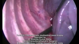 Thoracoscopic Pediatric anterior mediastinal mass biopsy by Dr Shandip Sinha,Pediatric Surgeon