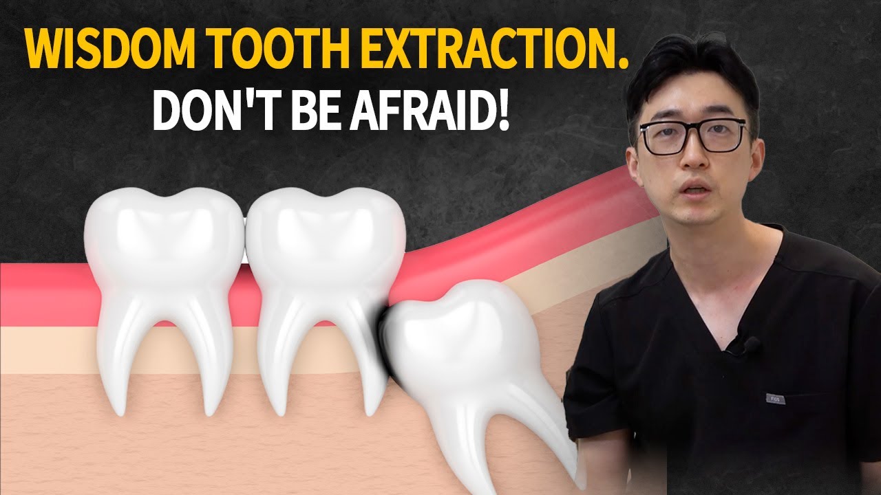 How to have a successful wisdom tooth extraction YouTube