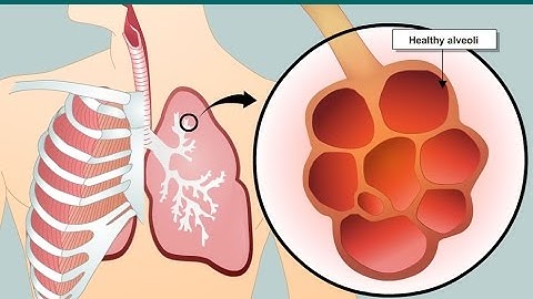 COPD and emphysema