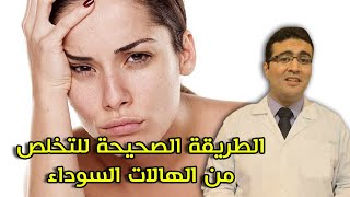 الهالات السوداء 