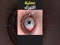 عملية الليزك سبحان الله اكسبلور Shorts عمليات جراحية شورت معلومات Eyes تكنولوجيا تكنولوجيا