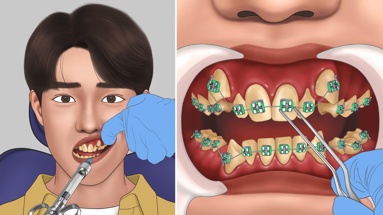 ASMR 리얼함 주의! 신기한 치아교정 애니메이션 | 치아 발치 | 덧니 | Amazing braces animation | Oddly Satisfying | Dental care