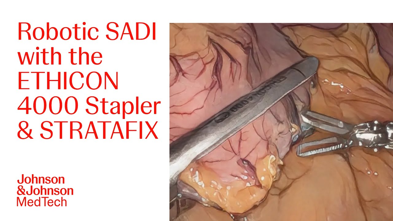 Robotic SADI Using the ETHICON 4000 Stapler and ETHICON 3D Reloads with Dr. Roberts | J&J MedTech