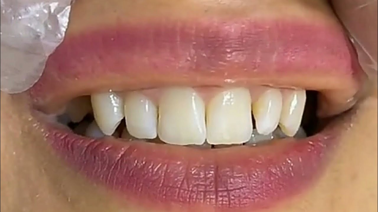 CLOSEUP VIDEO GIGI DAN MULUT | TEETH CLOSEUP