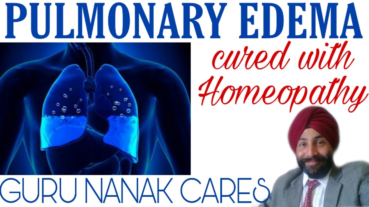 फेफड़ों में पानी भरना PULMONARY EDEMA Best Homeopathic Medicines