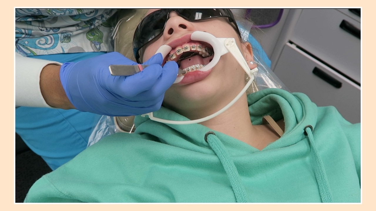 KATIE GETS BOTTOM BRACES | Flippin' Katie