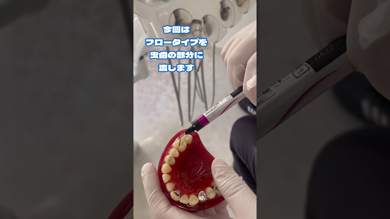 【コンポジットレジンの紹介】 #歯医者 #札幌