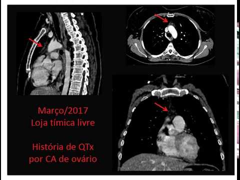 Video: Contributi Dell'involuzione Timica Legata All'età All'immunosenescenza E All'infiammazione