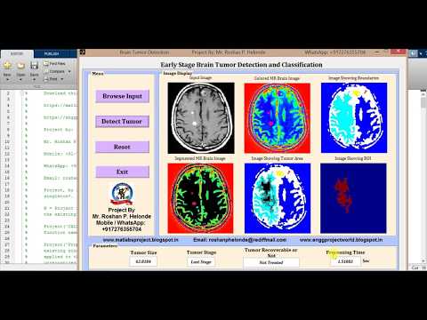 Matlab Code for Early Brain Tumor Detection with Tumor Stage using Image Processing