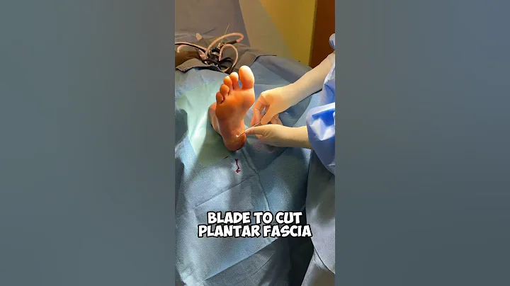 Plantar Fasciitis Surgery: A Step-by-Step Visual Guide #amazing