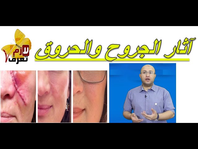 علاج اثار الحبوب ، اثار الجروح ، الحروق ، الندبات ، الخدوش والبقع الداكنة ، علاج اثار الجروح القديمة يوتيوب