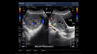 Ultrasound Video showing Hydatidiform Mole, also called Molar Pregnancy.