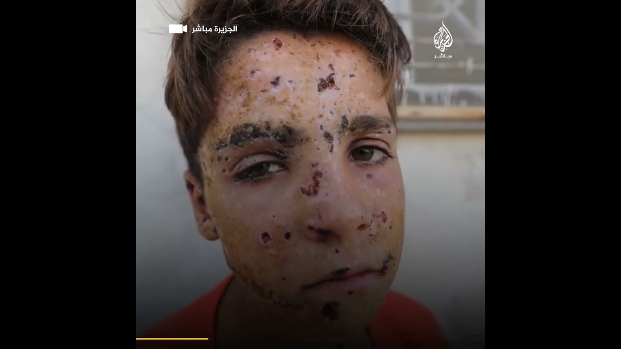 طفل أفقدته قذيفة من مخلفات الحرب يده اليمنى في شمال #سوريا