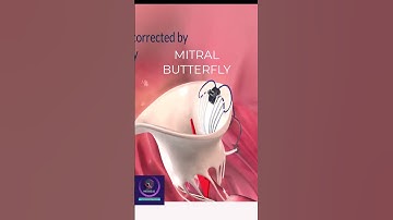 Mitral Valve Regurgitation - Corrected by Mitral Butterfly