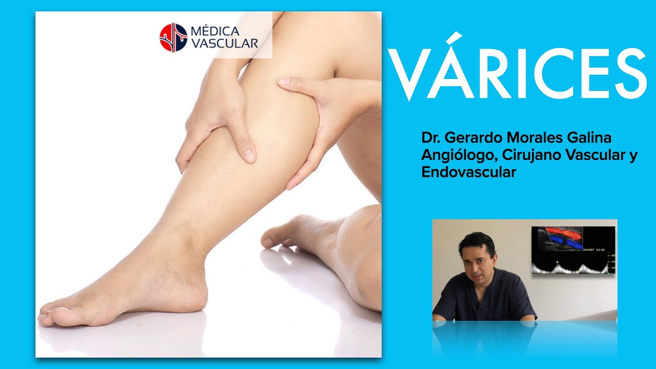 VARICES 