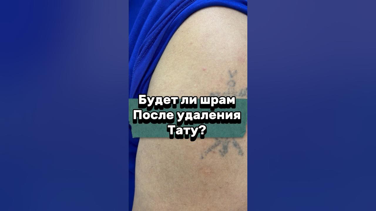 Будет ли шрам после удаления тату? #косметолог #дерматолог # ...