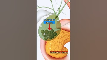Gallbladder Stones 3D Animation |Medical| #3d #medical