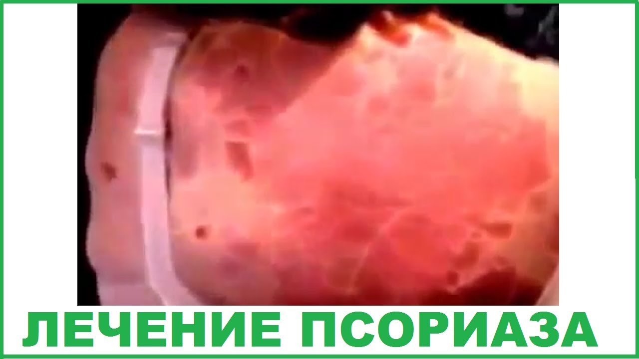 Смотреть Лечение псориаза видео Смотреть Лечение псориаза видео