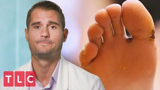 A Patient With Wart Clusters My Feet Are Killing Me Youtube