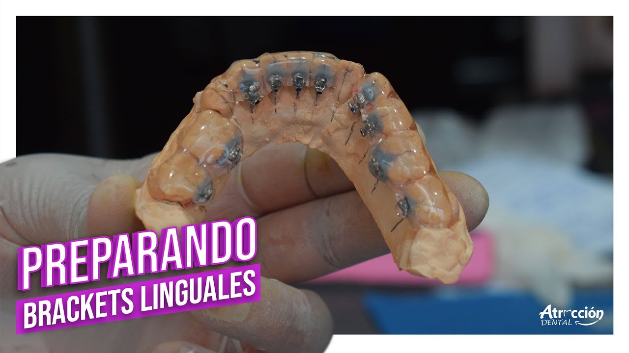 Como preparar la colocación de brackets linguales -