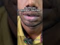 LIP VITILIGO PERMANENT TREATMENT VITILIGO CAMOUFLAGE Lips TREATMENT SAFEDDAAG ILAJ Vitiligo LIP VITILIGO PERMANENT TREATMENT VITILIGO CAMOUFLAGE Lips TREATMENT SAFEDDAAG ILAJ Vitiligo