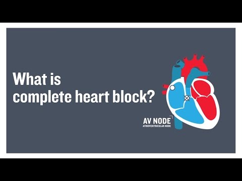 What is complete heart block?