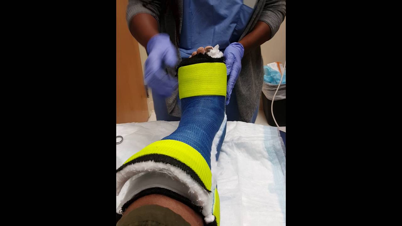 Cast Removal YouTube