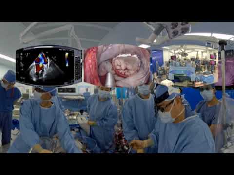 Metaverse Simulation (360-degree camera) of 3D Totally Endoscopic Mitral Valve Repair