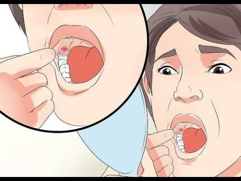 Video: Hoe Zwelling Van Een Tand Of Tandvlees Thuis Van Een Wang Te Verwijderen?