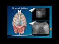 Introduction to lung ultrasound