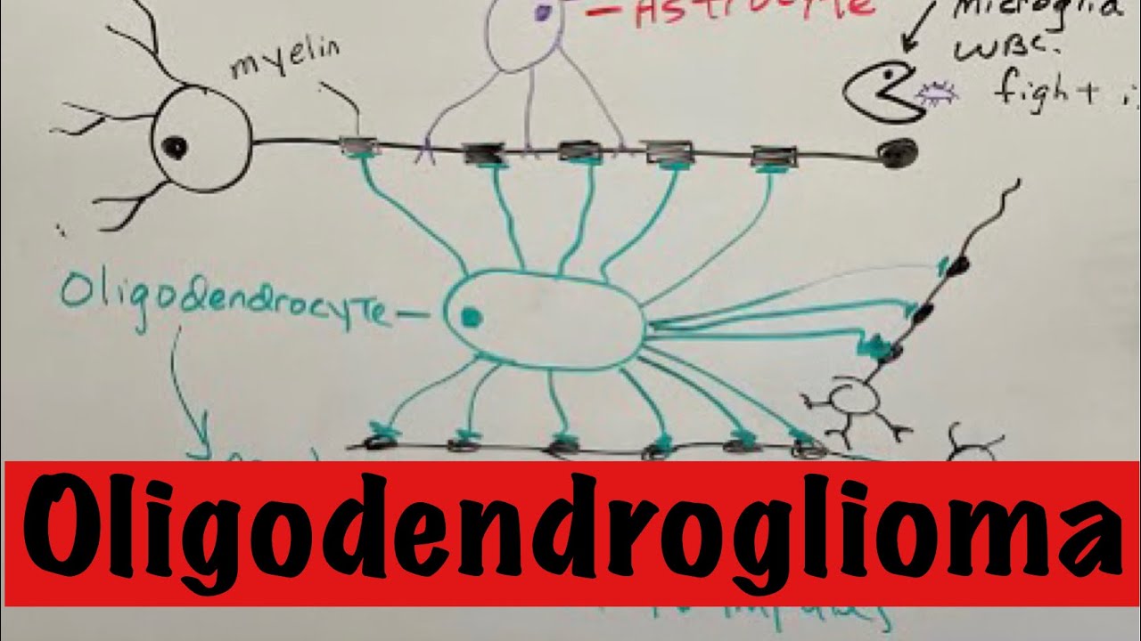 Олигодендроглиома