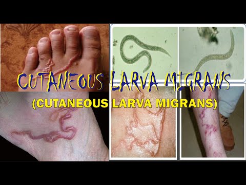 CUTANEOUS LARVA MIGRANS, Definisi, Penyebab, Gejala, Pengobatan, Komplikasi & Pencegahan