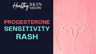 Progesterone Sensitivity RASH | Jennifer Fugo