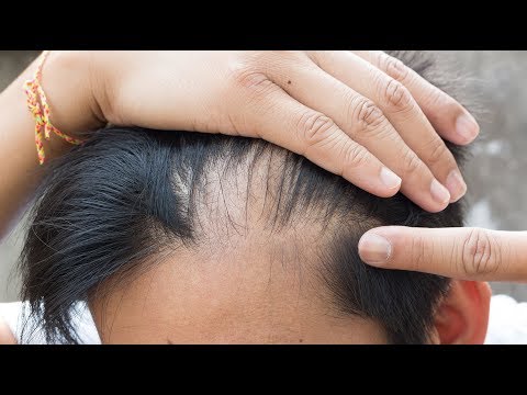 Спиронолактон и волосы