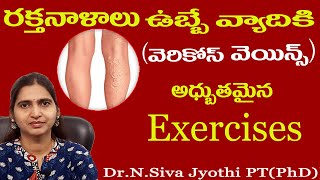 varicose veins | home exercises for varicose veins | blue veins | spider veins |