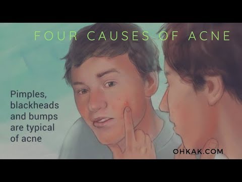 Sudden Acne Breakout on face and Causes