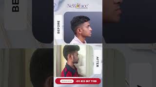 2 Weeks After Jaw surgery | Early Recovery Result | Dr Mathew PC