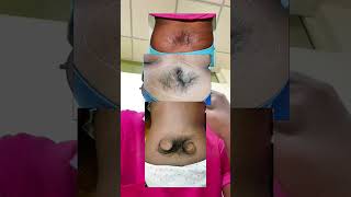 Occult spinal dysraphism