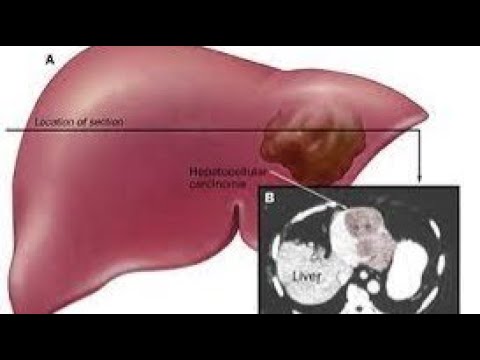 Печень 10 см. Гепатоцеллюлярная карцинома на УЗИ. Гепатоцеллюлярная карцинома печени. Гепатоцеллюлярная карцинома печени кт. Гепатоцеллюлярное поражение печени.